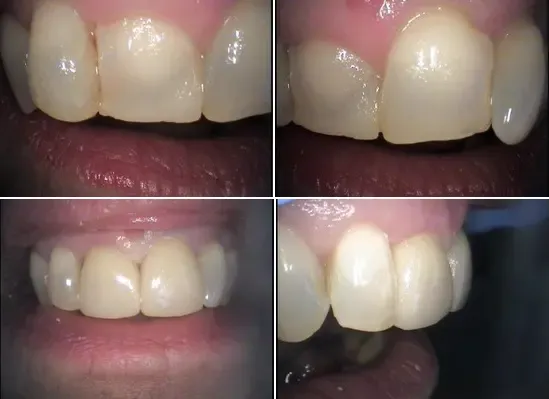 composite before and after dental crowns
