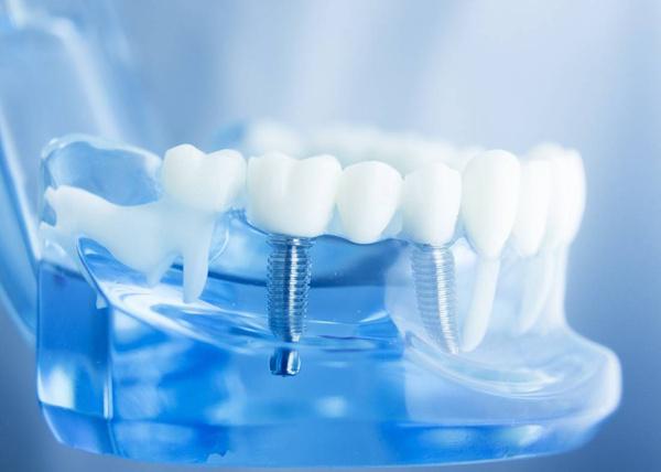 Dental Implants Ventura, CA