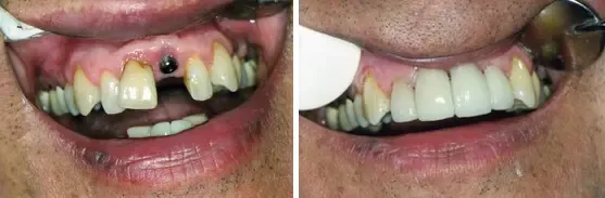 before and after of patient with dental crowns